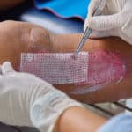 A nurse wearing white gloves applying a piece of gauze to a burn wound on a leg.