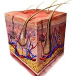 A medical illustration showing a cross-section of skin depicting a 1st degree burn.