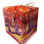 A medical illustration showing a cross-section of skin depicting a 2nd degree burn.