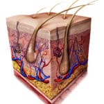 A medical illustration showing a cross-section of skin.