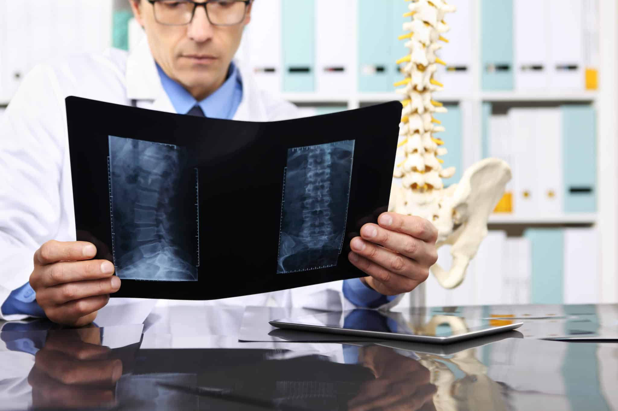 A male doctor holding up an x-ray of a lumbar spine.